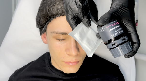 How Molecular Size Shapes the Depth and Effectiveness of Chemical Peels