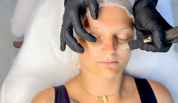 Microneedling course – comparing the standard and advanced versions