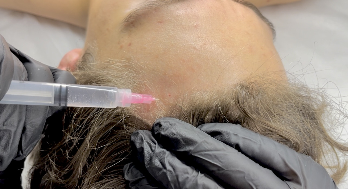 Online Hair Mesotherapy Course