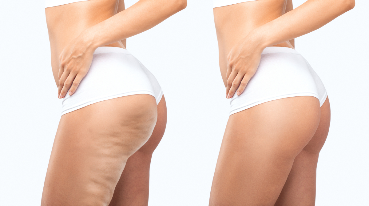 Cellulite Diagnosis & Treatment Online Course